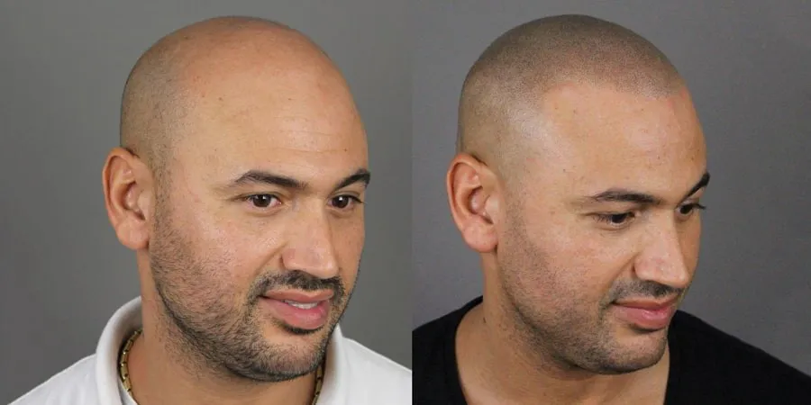 Saç Simülasyonu Fiyatları