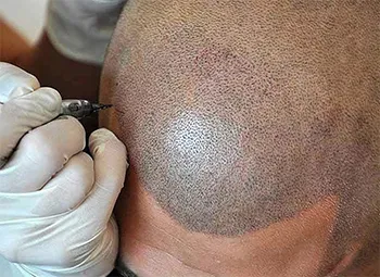 Saç Gölgelendirme Kimlere Yapılır?