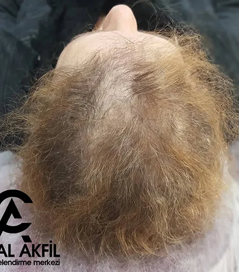 Saç Simülasyonu öncesi ve sonrası