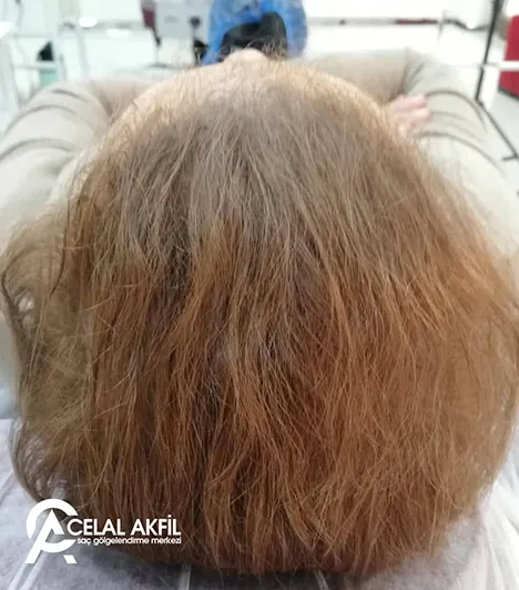 Saç Simülasyonu öncesi ve sonrası