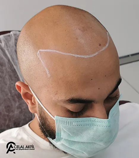 Saç Simülasyonu öncesi ve sonrası