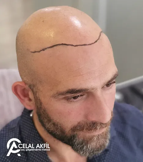 Saç Simülasyonu öncesi ve sonrası