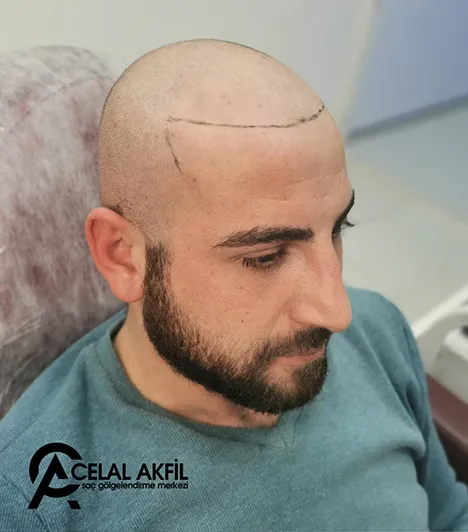 Saç Simülasyonu öncesi ve sonrası