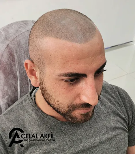 Saç Simülasyonu öncesi ve sonrası