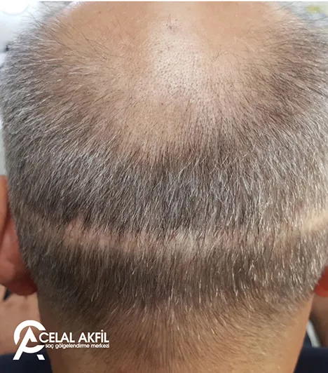 Saç Simülasyonu öncesi ve sonrası